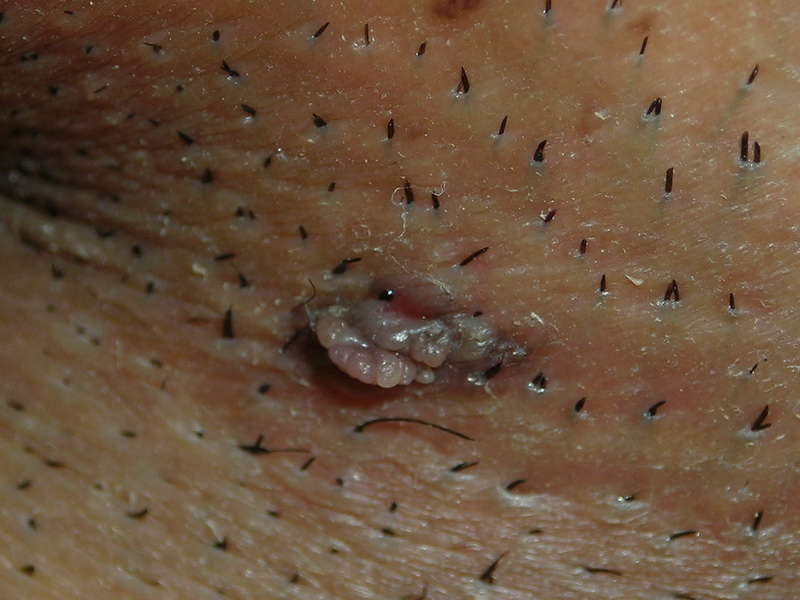 Black Mole On Penis 45